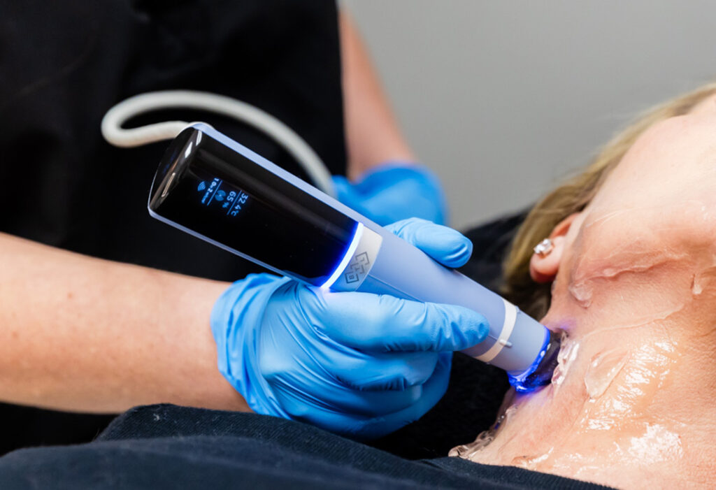 A close up of a patient's neck getting treated with skin tightening treatment in Louisville. The provider is wearing blue gloves, holding the large pen-shaped device, gliding the end along the patient's neck (which has gel on it).